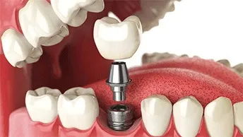 What Are Dental Implants And Their Costs?