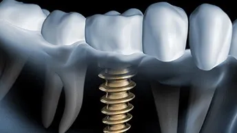 What Is The Average Cost Of Dental Implants In The US?