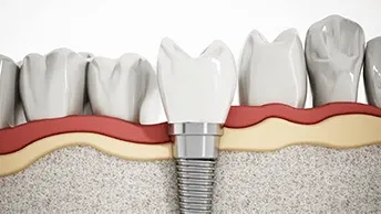 The Cost Of Permanent Dentures Can Range From $300 To $5,000 Per Plate