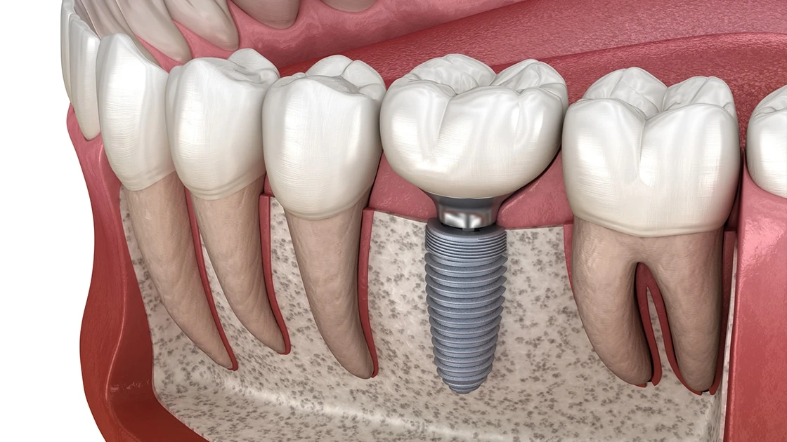 $399 Dental Implants: What You Need to Know