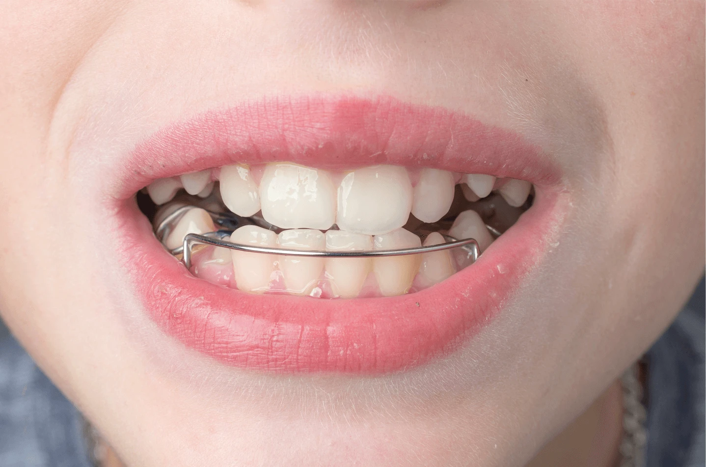 Unveiling the Benefits of Orthodontic Treatment