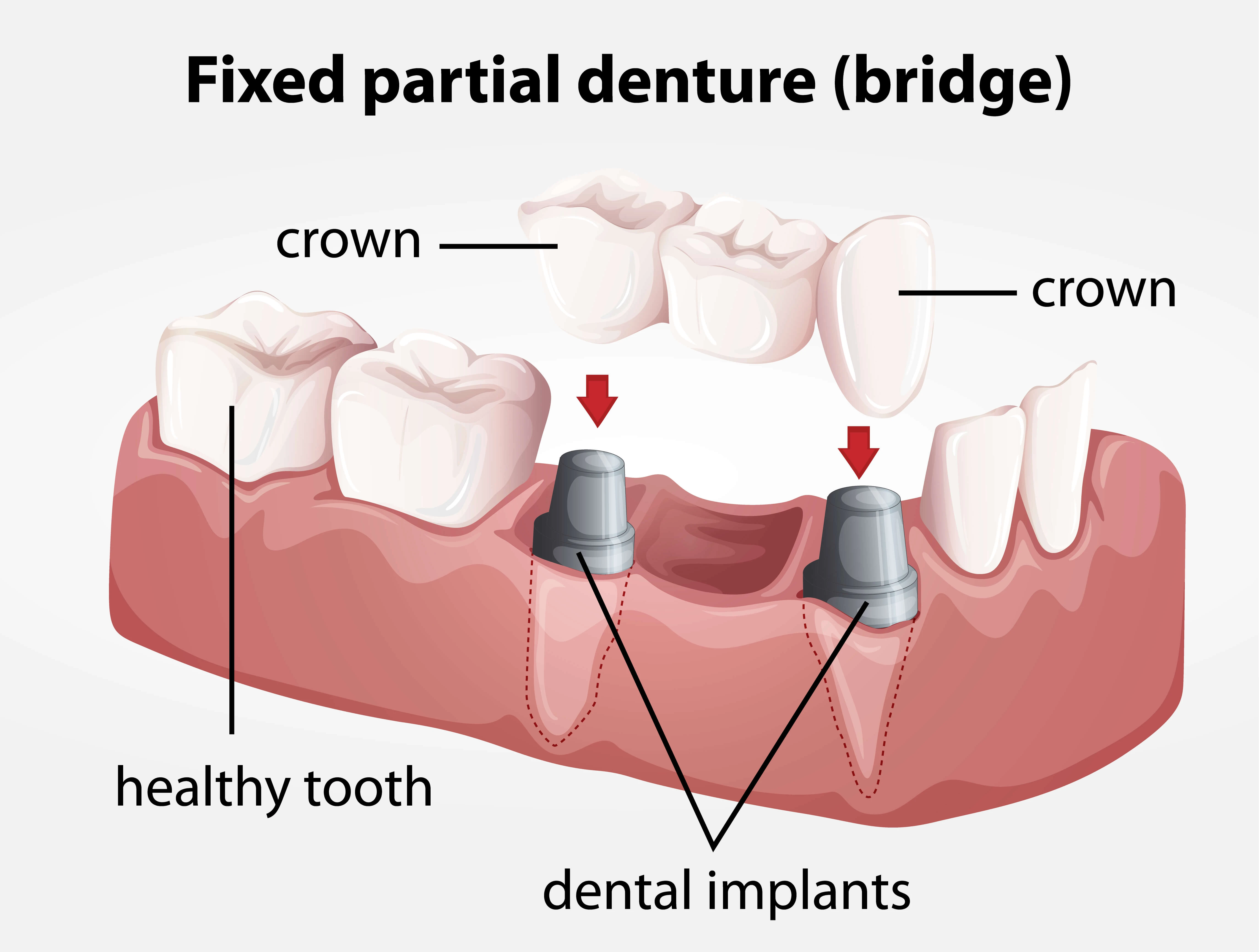 Dentures on a Budget: Affordable Options